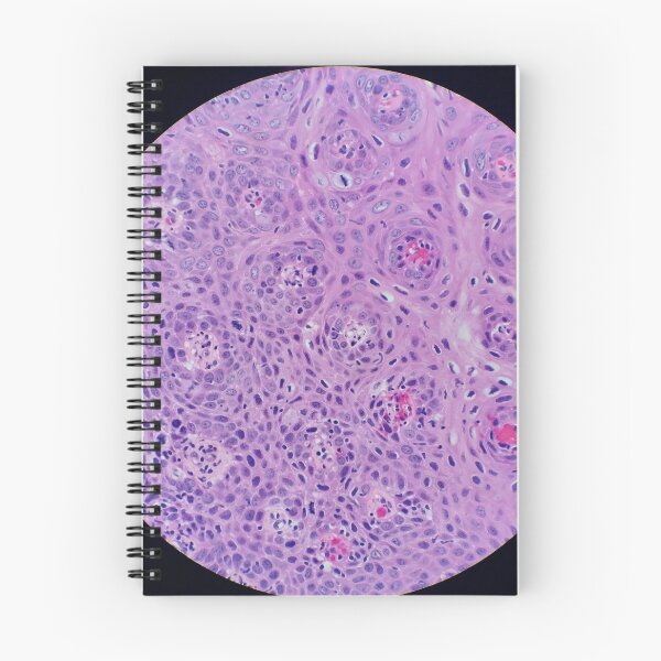Item preview, Skin histology, tangential, dysplastic, 200x H&E designed and sold by Psymier.