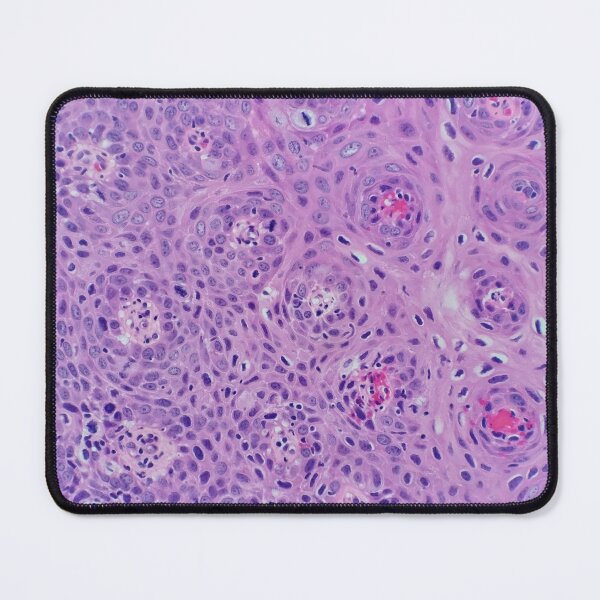 Item preview, Skin histology, tangential, dysplastic, 200x H&E designed and sold by Psymier.