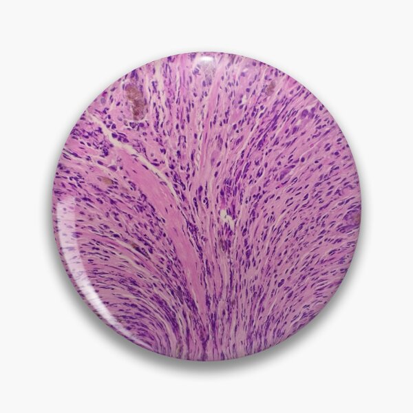Item preview, Histology of stomach, iron pill gastritis, H&E, 40x designed and sold by Psymier.