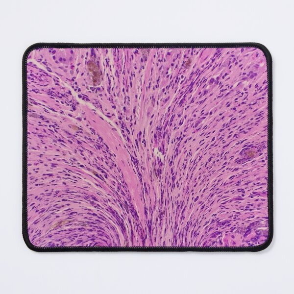 Item preview, Histology of stomach, iron pill gastritis, H&E, 40x designed and sold by Psymier.