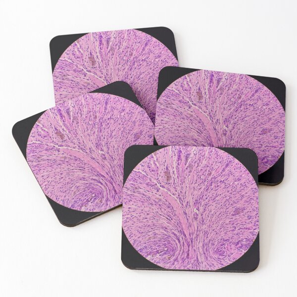 Item preview, Histology of stomach, iron pill gastritis, H&E, 40x designed and sold by Psymier.