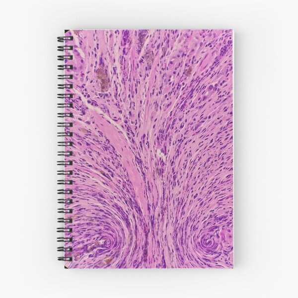 Item preview, Histology of stomach, iron pill gastritis, H&E, 40x designed and sold by Psymier.