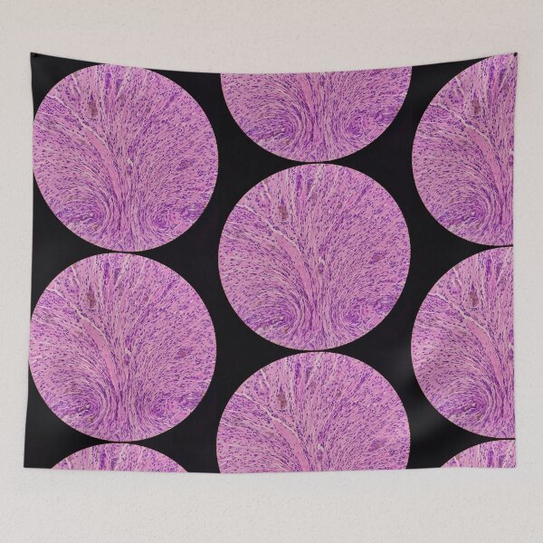 Item preview, Histology of stomach, iron pill gastritis, H&E, 40x designed and sold by Psymier.