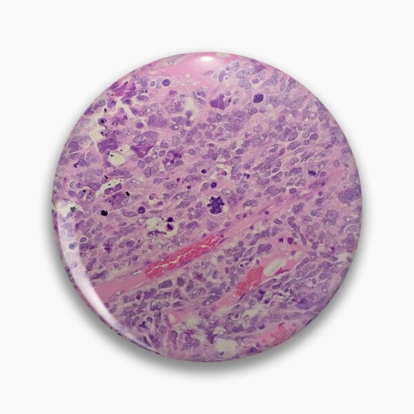 Item preview, Histology of malignant tumour, cancer, bizarre mitosis, H&E, 400x designed and sold by Psymier.