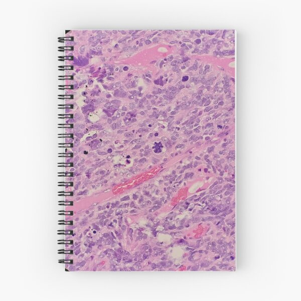 Item preview, Histology of malignant tumour, cancer, bizarre mitosis, H&E, 400x designed and sold by Psymier.
