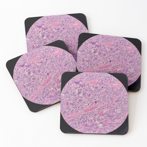 Item preview, Histology of malignant tumour, cancer, bizarre mitosis, H&E, 400x designed and sold by Psymier.