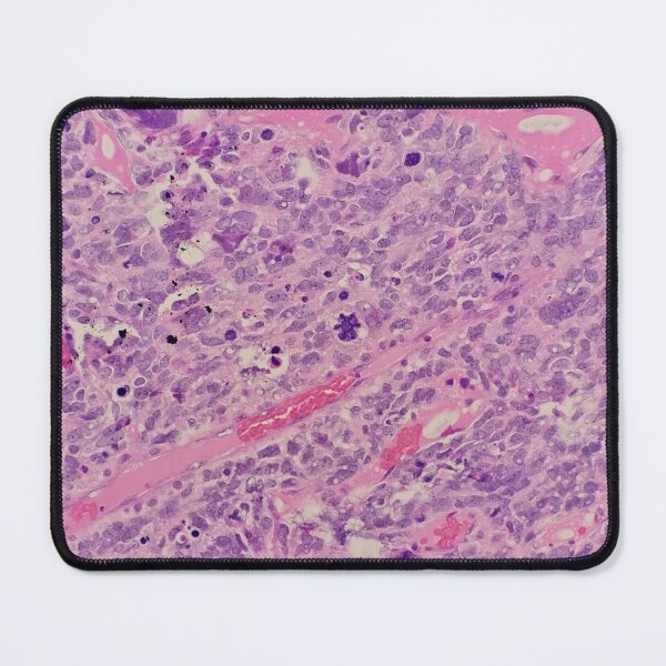 Item preview, Histology of malignant tumour, cancer, bizarre mitosis, H&E, 400x designed and sold by Psymier.