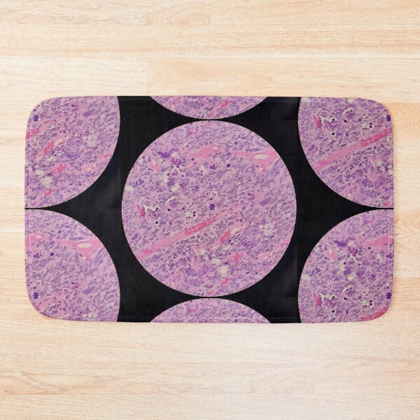 Item preview, Histology of malignant tumour, cancer, bizarre mitosis, H&E, 400x designed and sold by Psymier.