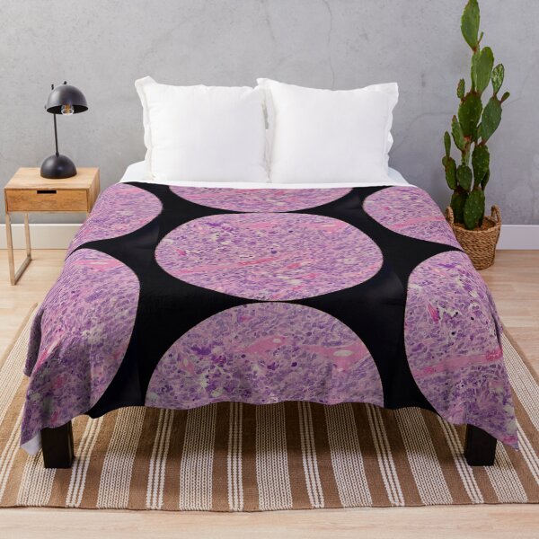 Item preview, Histology of malignant tumour, cancer, bizarre mitosis, H&E, 400x designed and sold by Psymier.