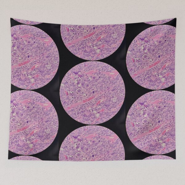 Item preview, Histology of malignant tumour, cancer, bizarre mitosis, H&E, 400x designed and sold by Psymier.