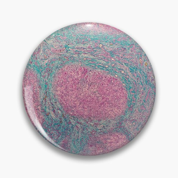 Item preview, Histology of liver cirrhosis, nodule, human tissue, Masson's trichrome, 40x designed and sold by Psymier.