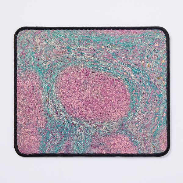 Item preview, Histology of liver cirrhosis, nodule, human tissue, Masson's trichrome, 40x designed and sold by Psymier.