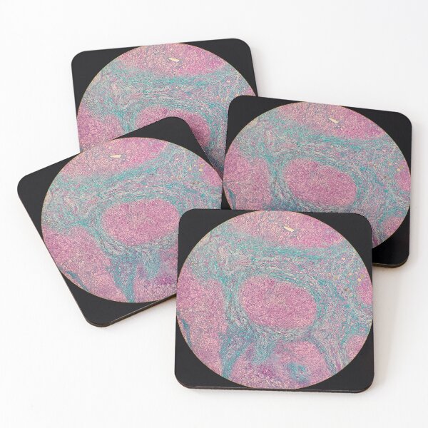 Item preview, Histology of liver cirrhosis, nodule, human tissue, Masson's trichrome, 40x designed and sold by Psymier.