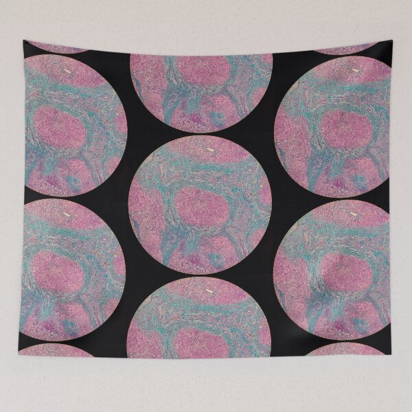 Item preview, Histology of liver cirrhosis, nodule, human tissue, Masson's trichrome, 40x designed and sold by Psymier.