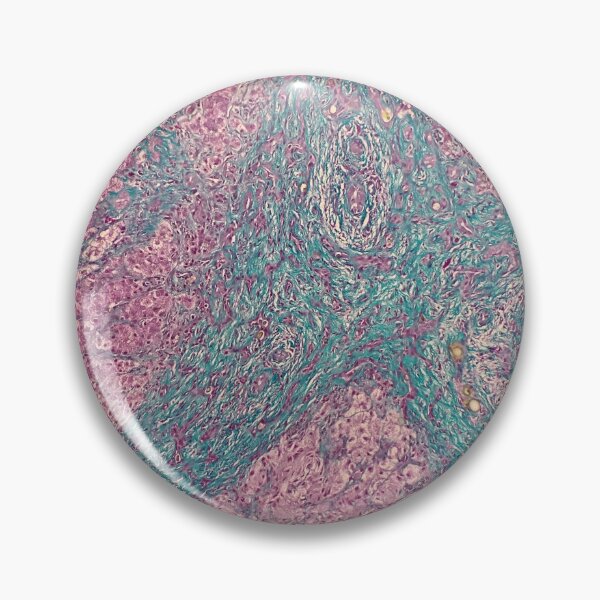 Item preview, Histology of liver cirrhosis, nodule, human tissue, Masson's trichrome, 100x designed and sold by Psymier.