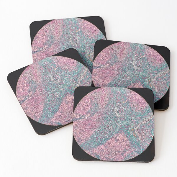 Item preview, Histology of liver cirrhosis, nodule, human tissue, Masson's trichrome, 100x designed and sold by Psymier.