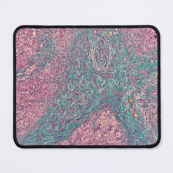 Item preview, Histology of liver cirrhosis, nodule, human tissue, Masson's trichrome, 100x designed and sold by Psymier.