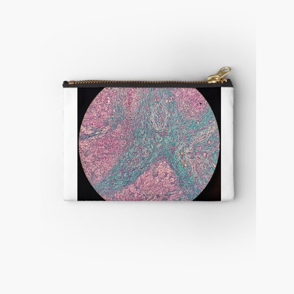 Item preview, Histology of liver cirrhosis, nodule, human tissue, Masson's trichrome, 100x designed and sold by Psymier.