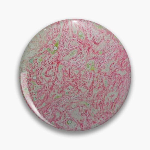 Item preview, Histology of liver cirrhosis, nodule, human tissue, Sirius red, 100x designed and sold by Psymier.