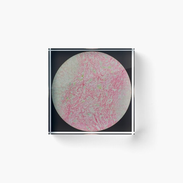 Item preview, Histology of liver cirrhosis, nodule, human tissue, Sirius red, 100x designed and sold by Psymier.