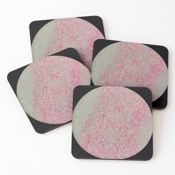 Item preview, Histology of liver cirrhosis, nodule, human tissue, Sirius red, 100x designed and sold by Psymier.