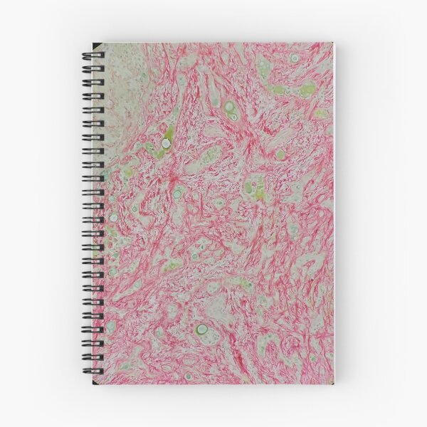 Item preview, Histology of liver cirrhosis, nodule, human tissue, Sirius red, 100x designed and sold by Psymier.