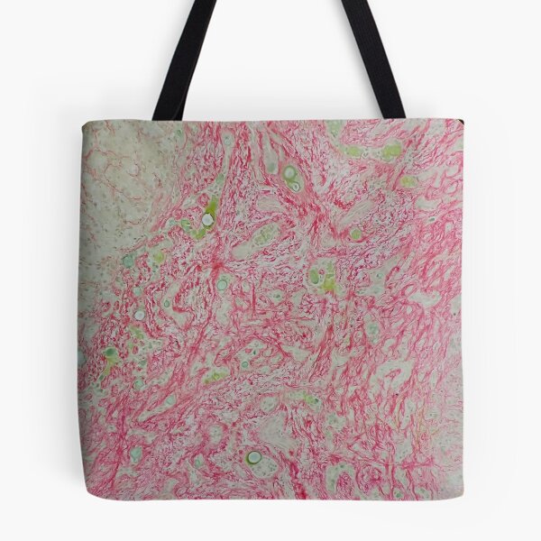Item preview, Histology of liver cirrhosis, nodule, human tissue, Sirius red, 100x designed and sold by Psymier.