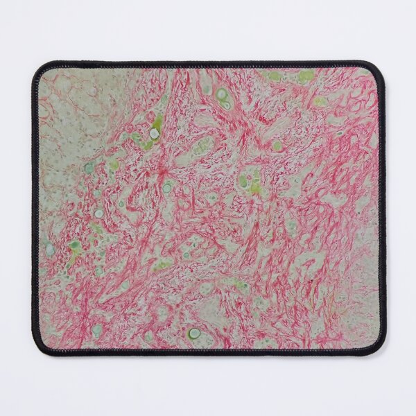 Item preview, Histology of liver cirrhosis, nodule, human tissue, Sirius red, 100x designed and sold by Psymier.