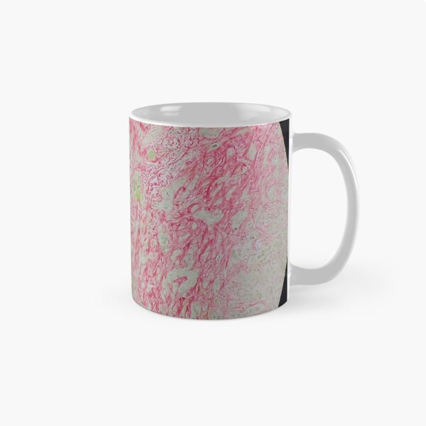 Item preview, Histology of liver cirrhosis, nodule, human tissue, Sirius red, 100x designed and sold by Psymier.
