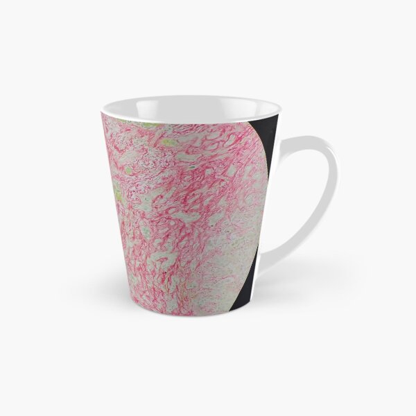 Item preview, Histology of liver cirrhosis, nodule, human tissue, Sirius red, 100x designed and sold by Psymier.