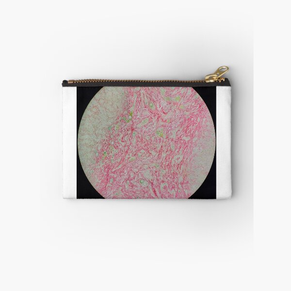 Item preview, Histology of liver cirrhosis, nodule, human tissue, Sirius red, 100x designed and sold by Psymier.
