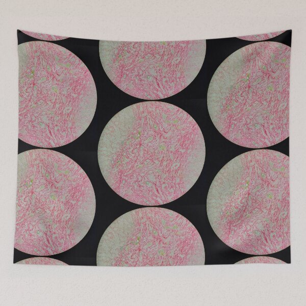 Item preview, Histology of liver cirrhosis, nodule, human tissue, Sirius red, 100x designed and sold by Psymier.