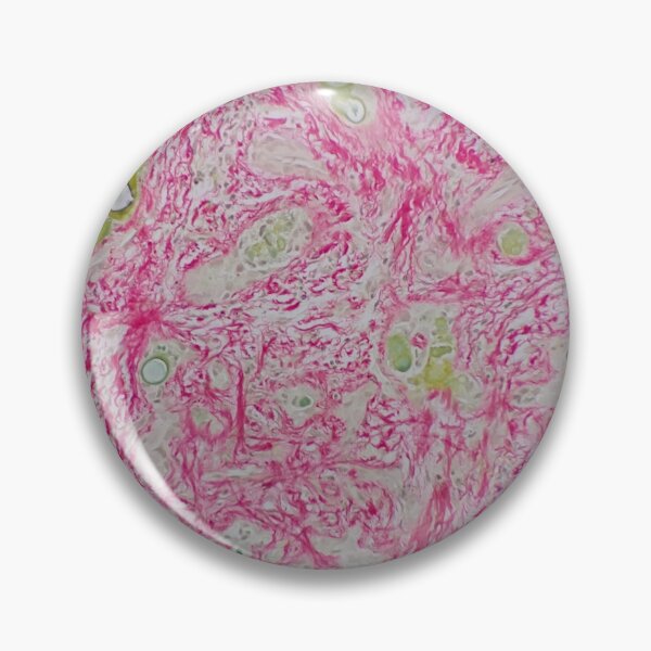 Item preview, Histology of liver cirrhosis, nodule, human tissue, Sirius red, 200x designed and sold by Psymier.
