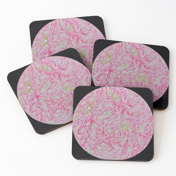 Item preview, Histology of liver cirrhosis, nodule, human tissue, Sirius red, 200x designed and sold by Psymier.