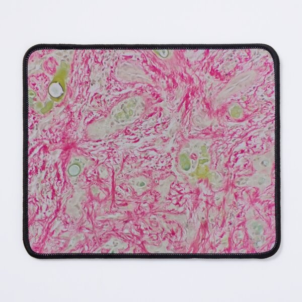 Item preview, Histology of liver cirrhosis, nodule, human tissue, Sirius red, 200x designed and sold by Psymier.
