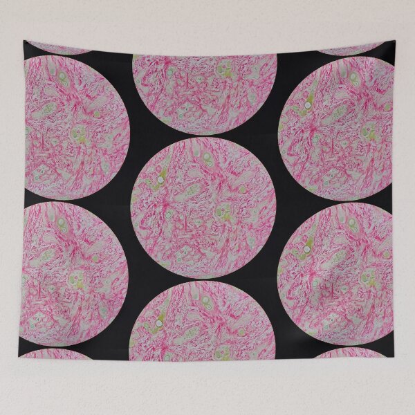 Item preview, Histology of liver cirrhosis, nodule, human tissue, Sirius red, 200x designed and sold by Psymier.