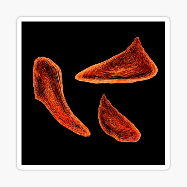 Item preview, Sickle cell anaemia, illustration (F010/8336) designed and sold by SciencePhoto.