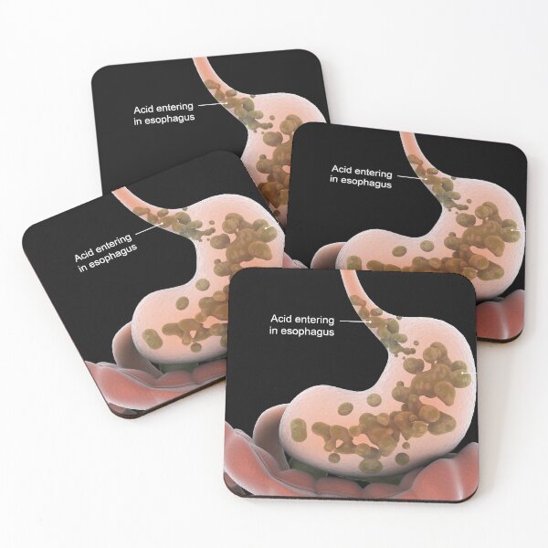 Item preview, STK701293H-Acid reflux in the stomach. designed and sold by StocktrekImages.