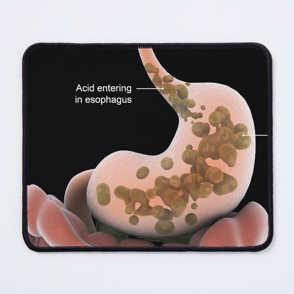 Item preview, STK701293H-Acid reflux in the stomach. designed and sold by StocktrekImages.