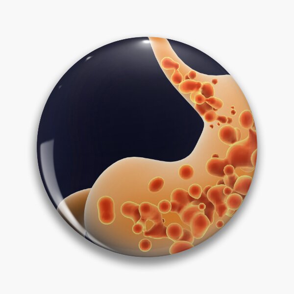 Item preview, STK701294H-Acid reflux in human stomach. designed and sold by StocktrekImages.