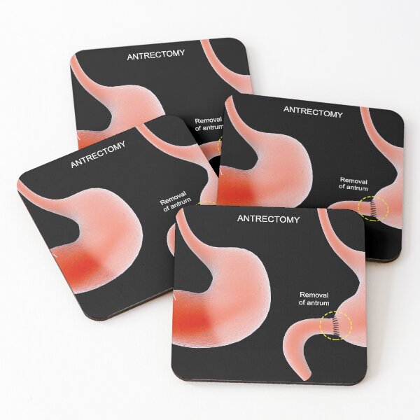 Item preview, STK701295H-Antrectomy procedure of the human stomach. designed and sold by StocktrekImages.