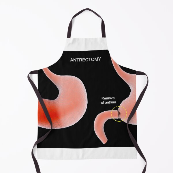 Item preview, STK701295H-Antrectomy procedure of the human stomach. designed and sold by StocktrekImages.
