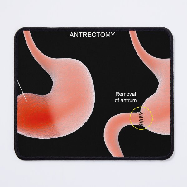 Item preview, STK701295H-Antrectomy procedure of the human stomach. designed and sold by StocktrekImages.