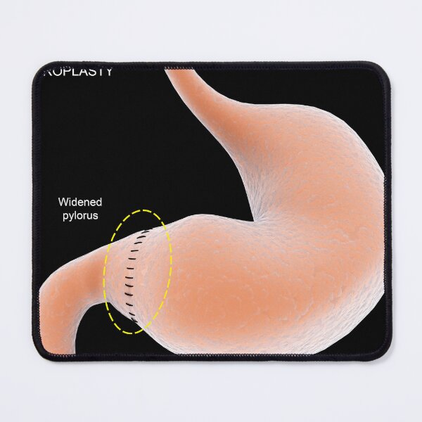 Item preview, STK701296H-Pyloroplasty, which widens the pylorus in stomach. designed and sold by StocktrekImages.
