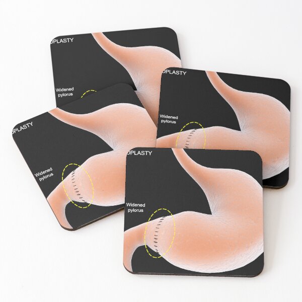 Item preview, STK701296H-Pyloroplasty, which widens the pylorus in stomach. designed and sold by StocktrekImages.