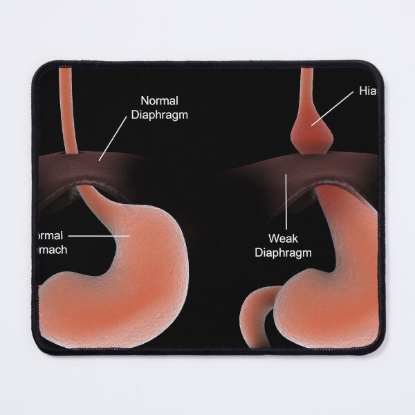 Item preview, STK701297H-A healthy stomach compared to an unhealthy stomach with hiatal hernia. designed and sold by StocktrekImages.