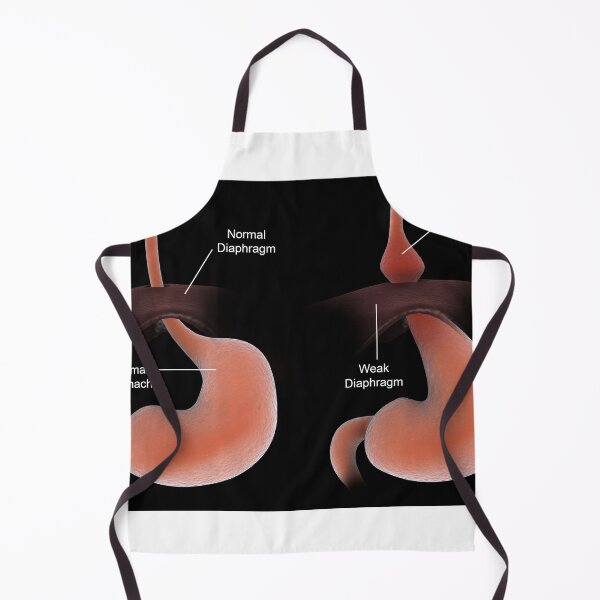 Item preview, STK701297H-A healthy stomach compared to an unhealthy stomach with hiatal hernia. designed and sold by StocktrekImages.
