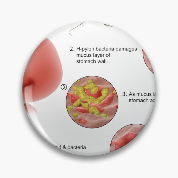 Item preview, STK701298H-Helicobacter pylori bacteria entering the stomach and causing ulcers. designed and sold by StocktrekImages.
