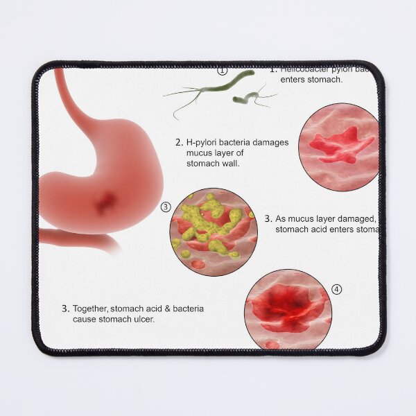 Item preview, STK701298H-Helicobacter pylori bacteria entering the stomach and causing ulcers. designed and sold by StocktrekImages.