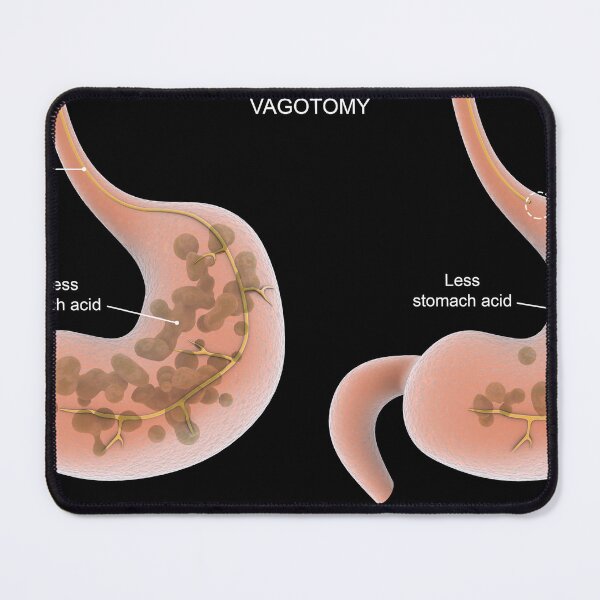 Item preview, STK701300H-Vagotomy surgical procedure to remove part of the vagus nerve. designed and sold by StocktrekImages.